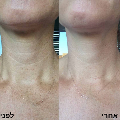 פאטצ' Elovate לטיפול ממוקד לקמטי צוואר